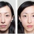 自体脂肪丰面颊