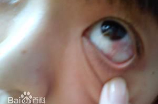 眼白髮红