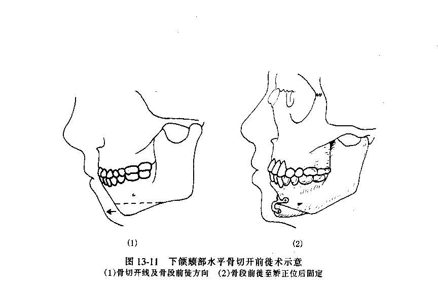 下颏成型术 下颏成型术