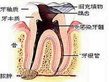 颌骨骨髓炎 颌骨骨髓炎