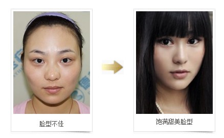 德阳德美整形谘询师宋思思案例 德阳德美整形谘询师宋思思案例