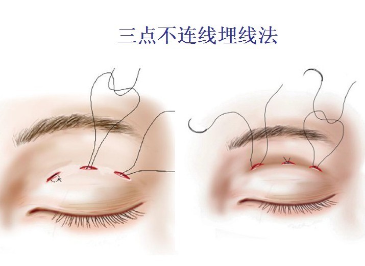 眼部整形术