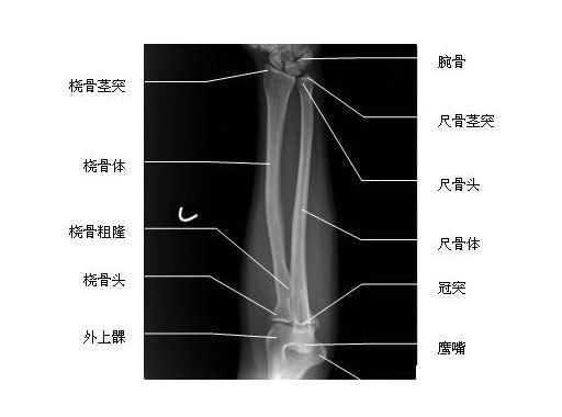桡骨