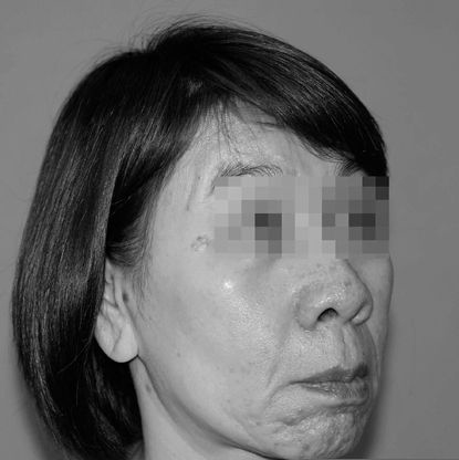 获得性面部皮肤衰老症 获得性面部皮肤衰老症