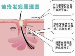 痤疮生成机制 痤疮生成机制