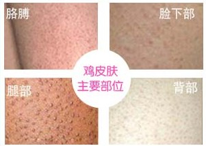 鸡皮肤症状 鸡皮肤症状