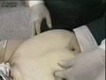 腹壁鬆弛需腹壁整形术 腹壁鬆弛需腹壁整形术
