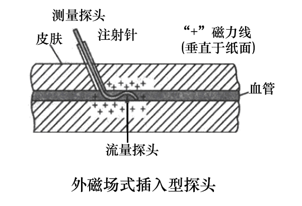 外磁场式插入行血流感测器 外磁场式插入行血流感测器