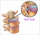 钩椎关节 钩椎关节