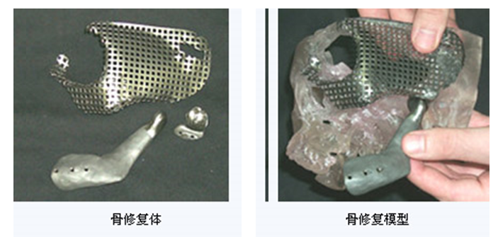 人工颅骨 人工颅骨