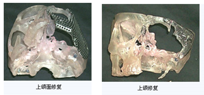 人工颅骨 人工颅骨