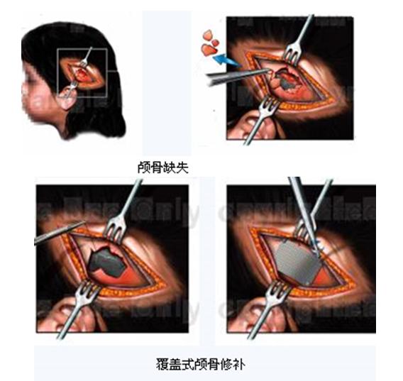 人工颅骨 人工颅骨