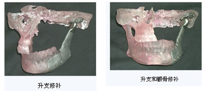 人工颅骨 人工颅骨