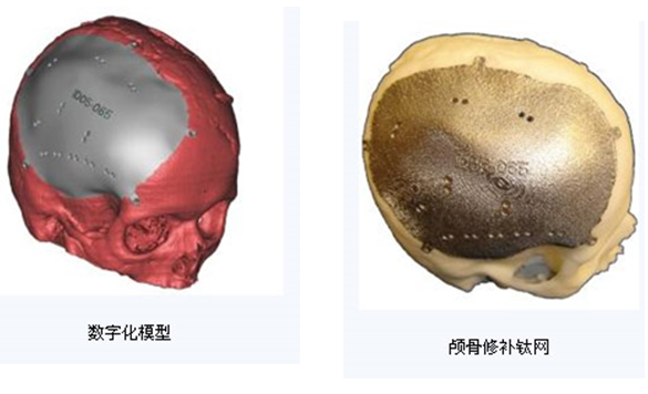 人工颅骨 人工颅骨