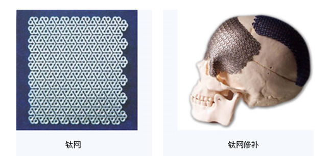 人工颅骨 人工颅骨