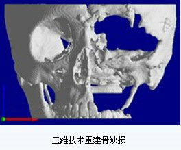 人工颅骨 人工颅骨