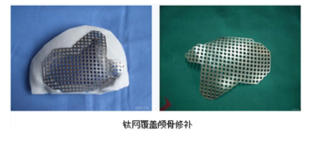 人工颅骨 人工颅骨